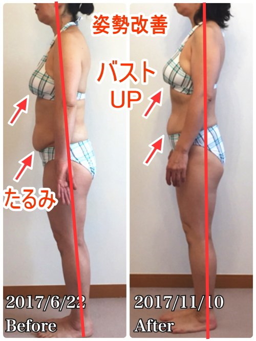 骨盤臓器脱がベルト装着で完全に治り、スタイルも良くなった!後ろ姿