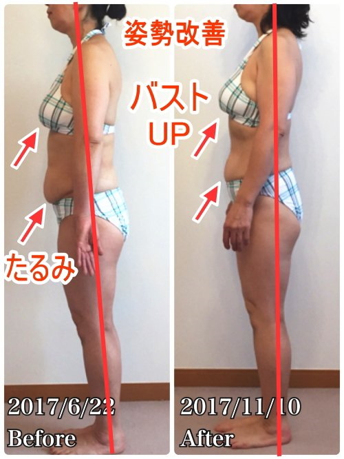 骨盤臓器脱がベルト装着で完全に治り、スタイルも良くなった！後ろ姿